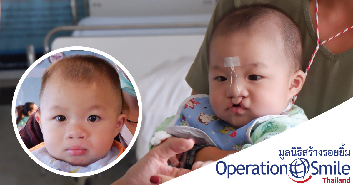 Operation Smile